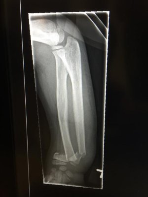 brady's broken arm 009.jpg